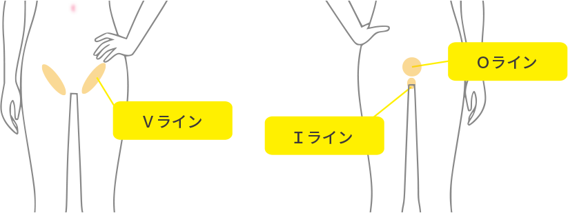 VIO脱毛の料金